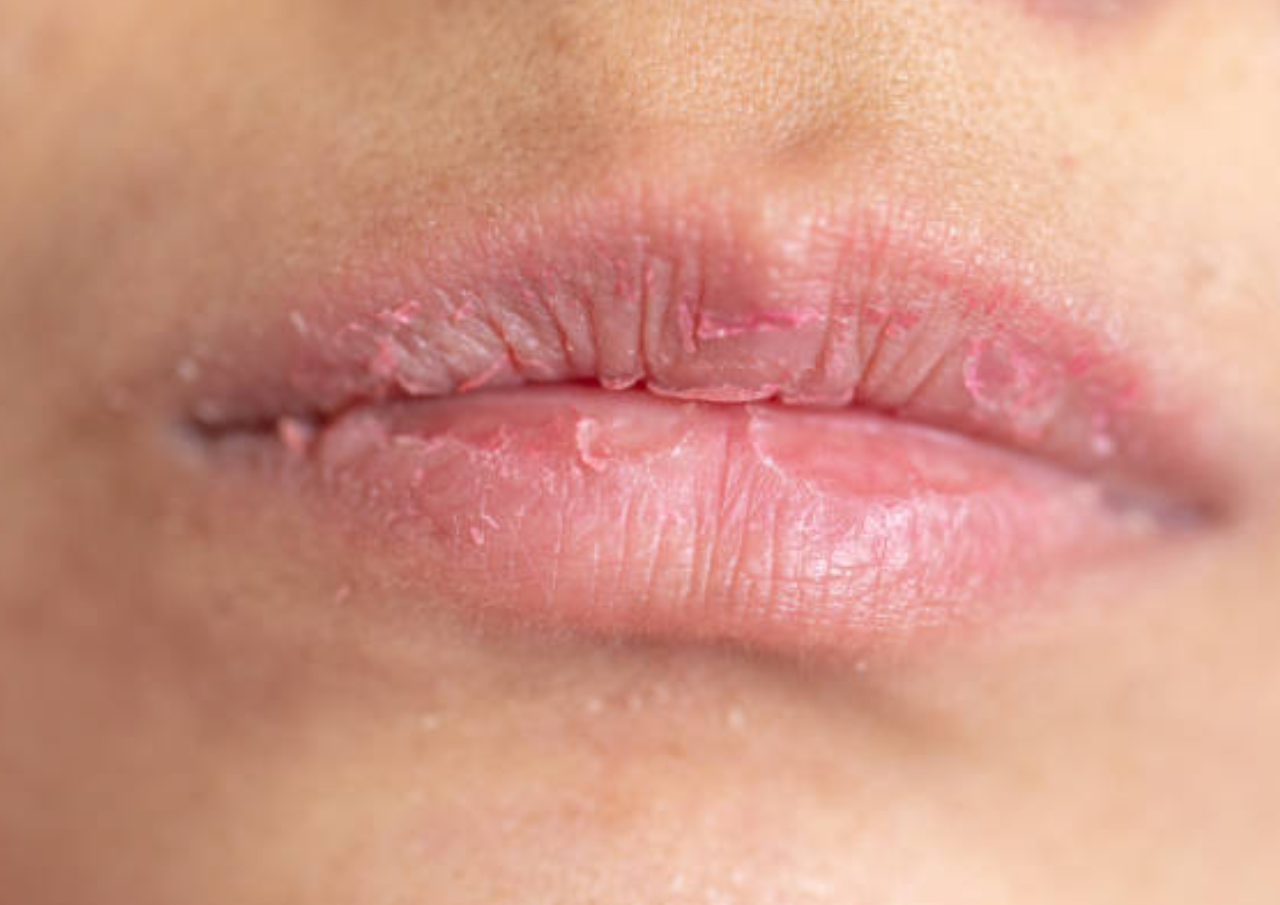 Cara Mudah Atasi Bibir Pecah-pecah