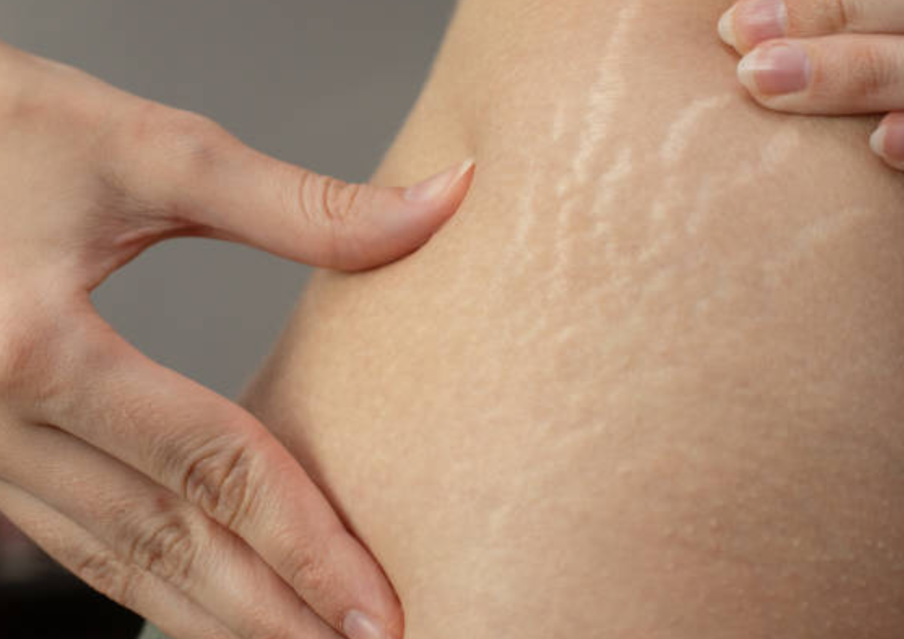 Cara Menghilangkan Stretch Mark di Tubuh