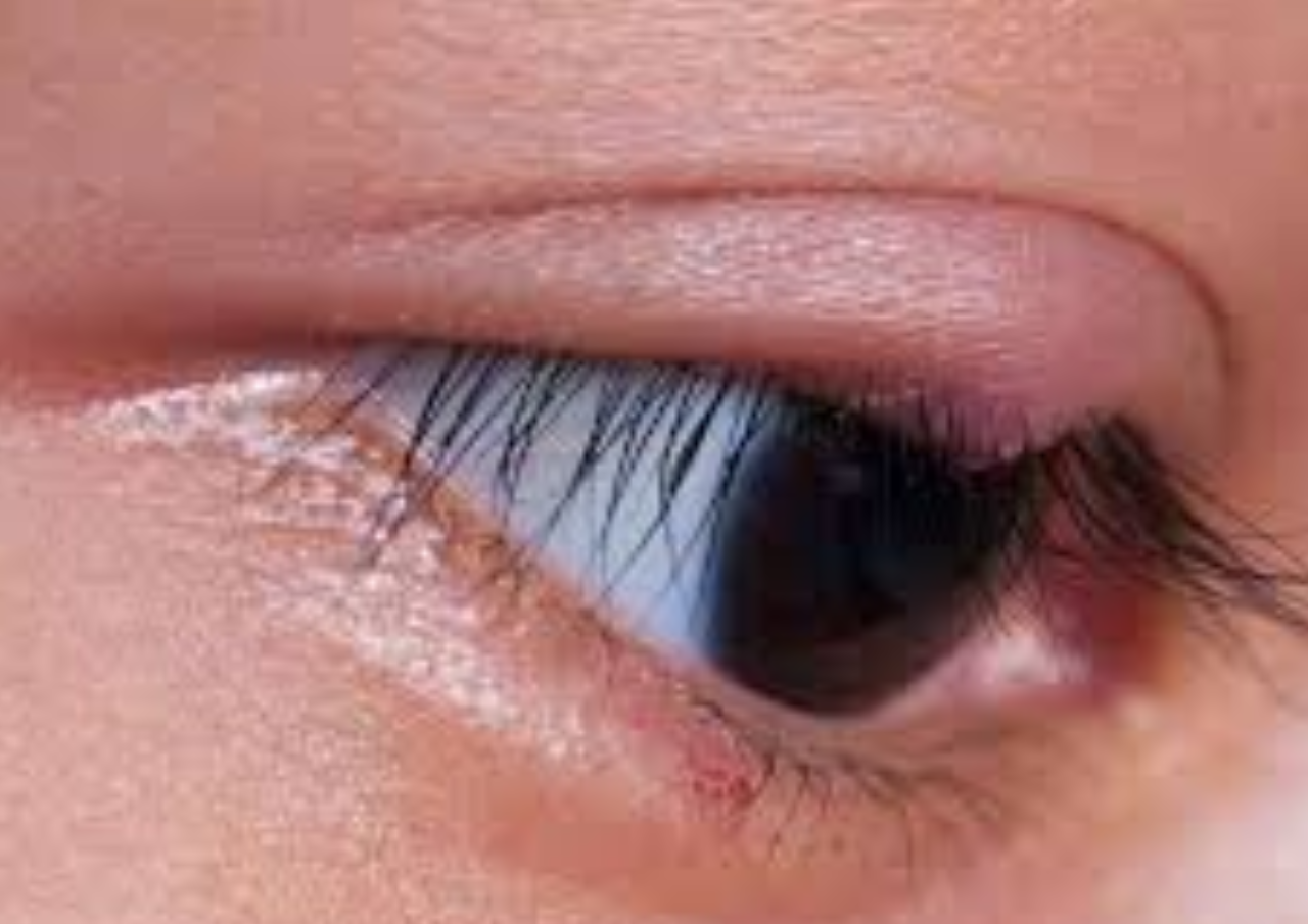 Bintitan Muncul karena Sering Mengintip, Benarkah