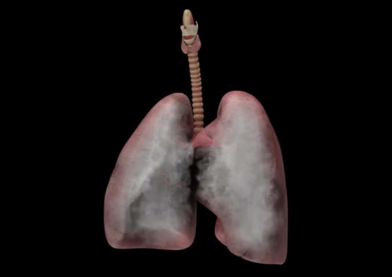 Penyebab Paru-paru Basah