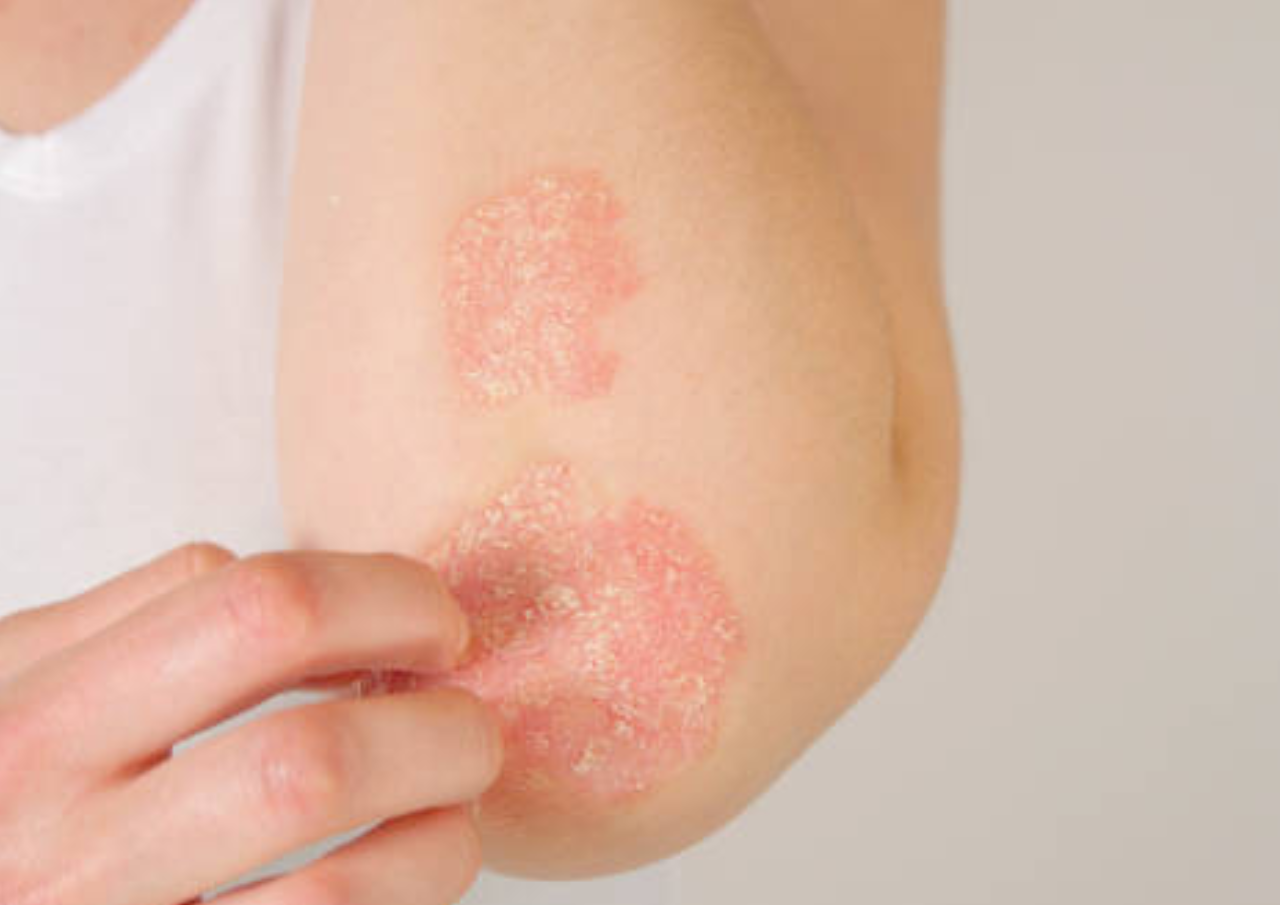 Mengenal Psoriasis dan Cara Mengobatinya