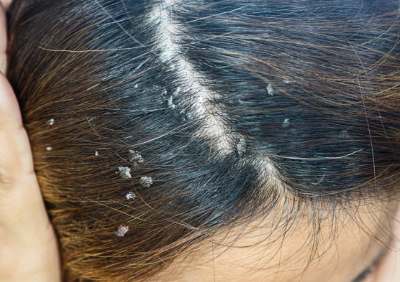 Sering Mengalami Kulit Kepala Gatal Ini Penyebabnya